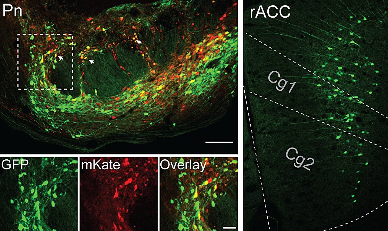 Along the 'placebo pathway', the cells in yellow in the pons (left) receive input from the green cells in the cingulate cortex (rACC, right), with subdivisions Cg1 and Cg2