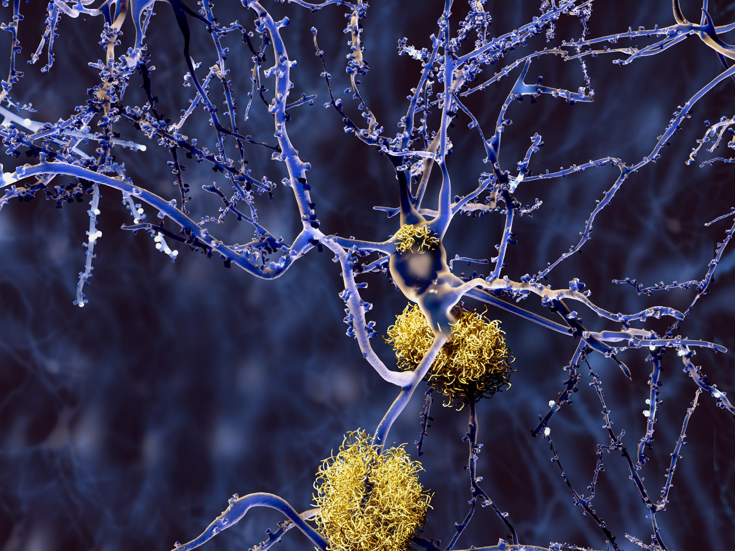 Amyloid-beta plaques in the brain are one of the potential culprits behind Alzheimer's disease