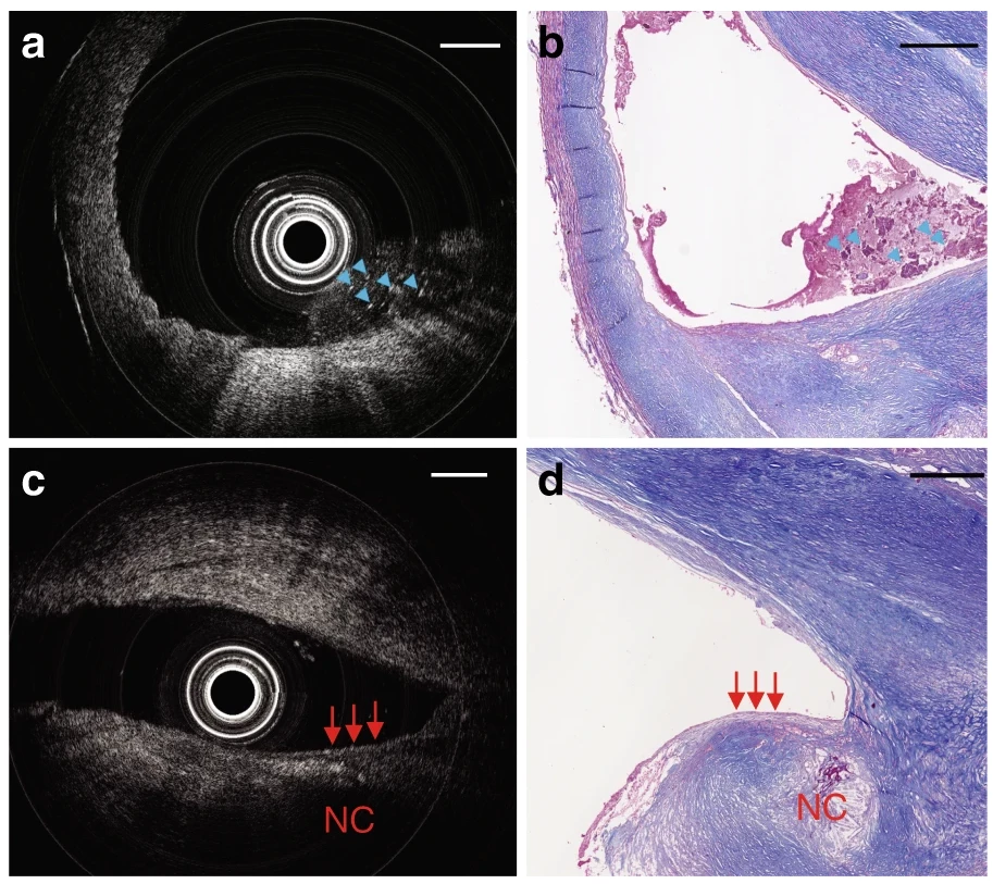 OCT imaging of a severely diseased human carotid artery, using this ultra-thin probe