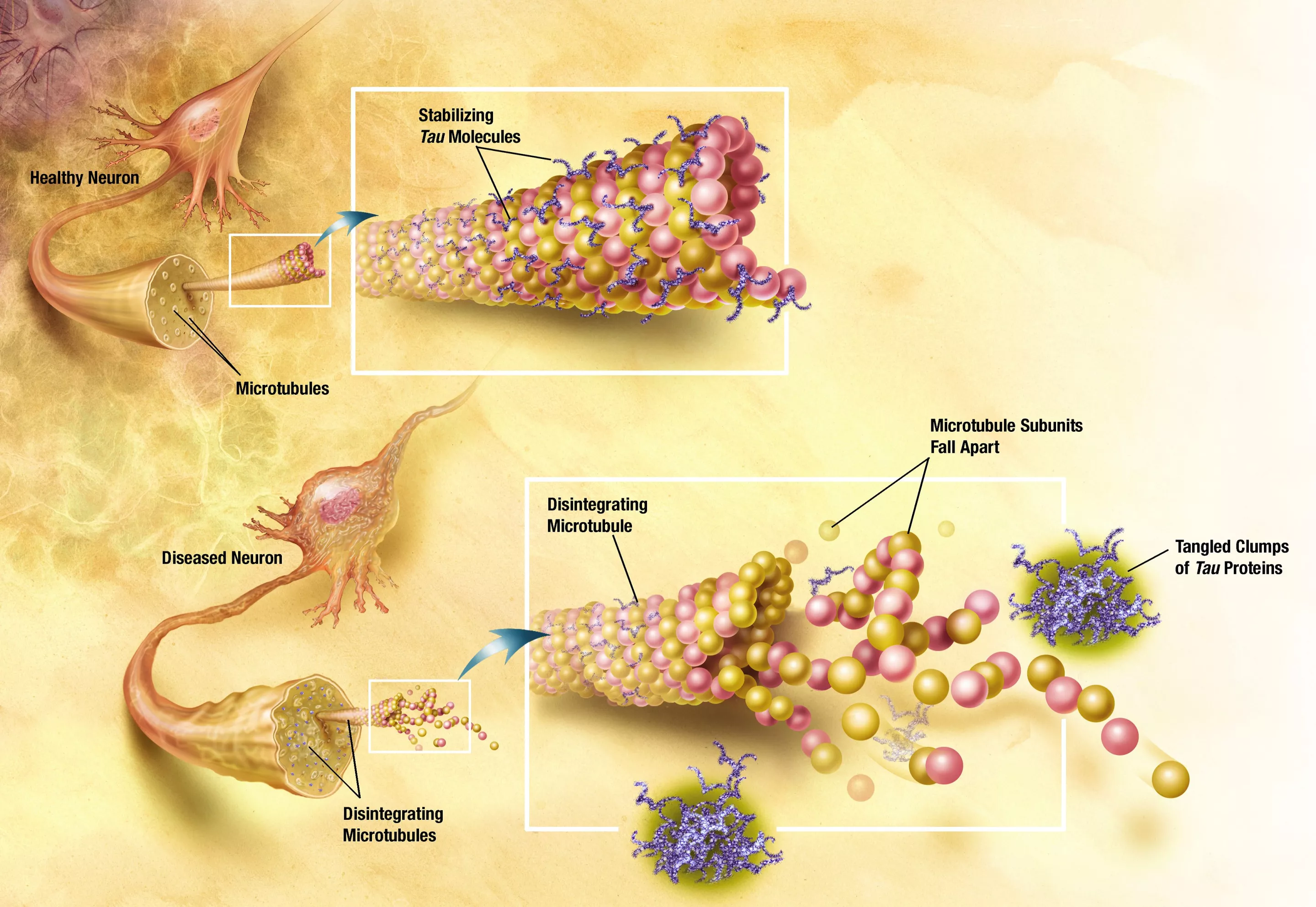 Artist's conception of normal and tangled tau proteins in the microtubules of neurons (Photo: National Institute on Aging)