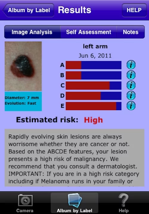 MelApp risk assessment tool for skin cancer