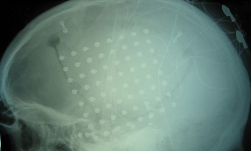 X-ray showing the BCI implanted on the surface of a patient's brain