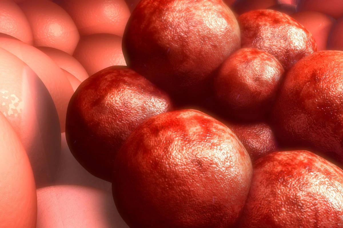 Researchers have reprogrammed immune cells that were previously hijacked by cancer to wipe out the disease