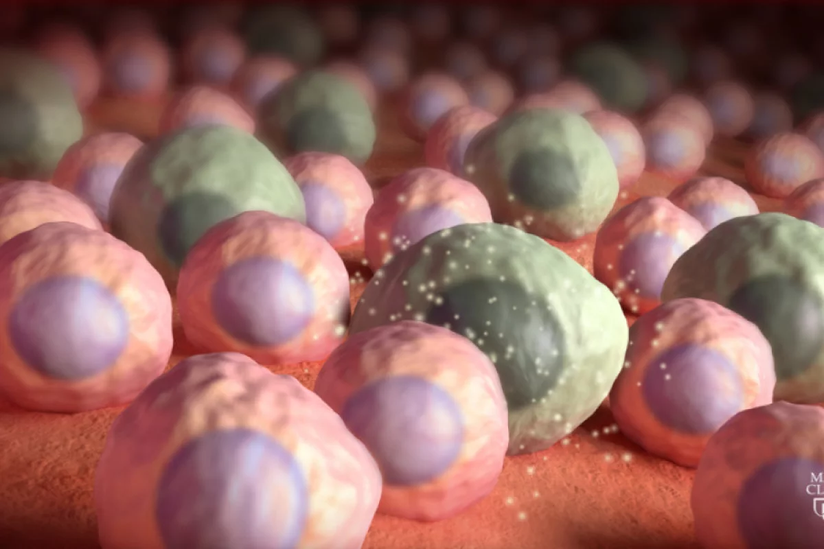 Zombie cells, aka senescent cells, have been found to accumulate in the brain ahead of the toxic protein build-ups that are generally implicated in Alzheimer's disease and dementia