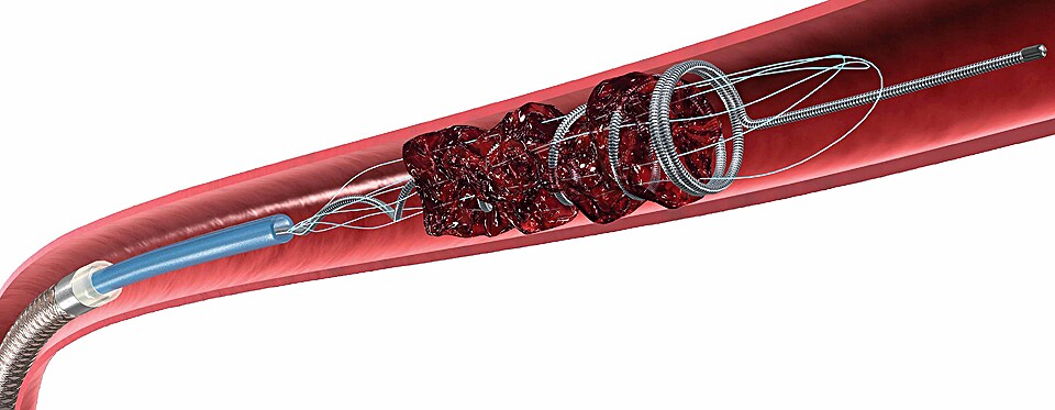 A cerebral blood clot captured by the Concentric Medical Merci Retriever (Image: Concentric Medical)
