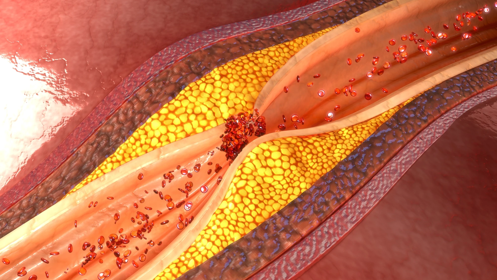 Researchers have discovered a protein that could be targeted to prevent plaque buildup in arteries