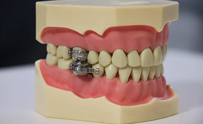 Silicone-based cheek protectors stop the DentalSlim device from cutting patients' mouths