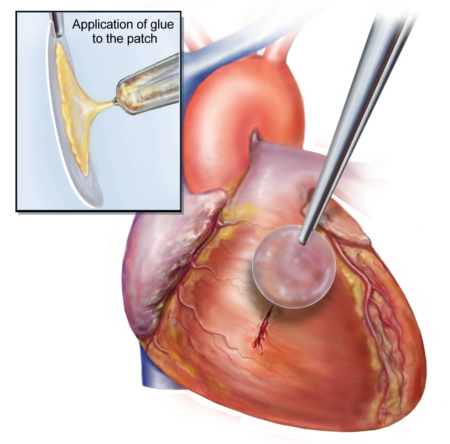 Applying a biodegradable patch to a heart defect, using HLAA