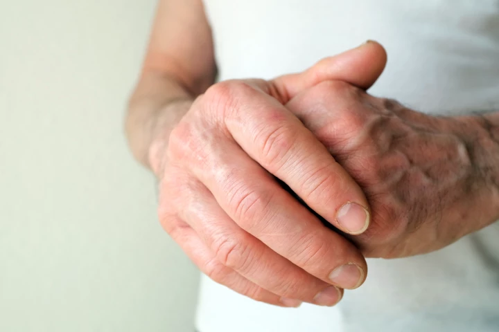 Immune biomarkers offer a way to diagnose, treat, and possibly prevent rheumatoid arthritis