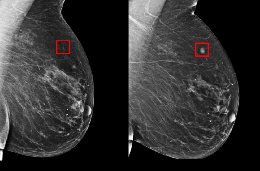 On the left is an example of an early mammogram pattern that the AI system could predict becoming cancerous in the future