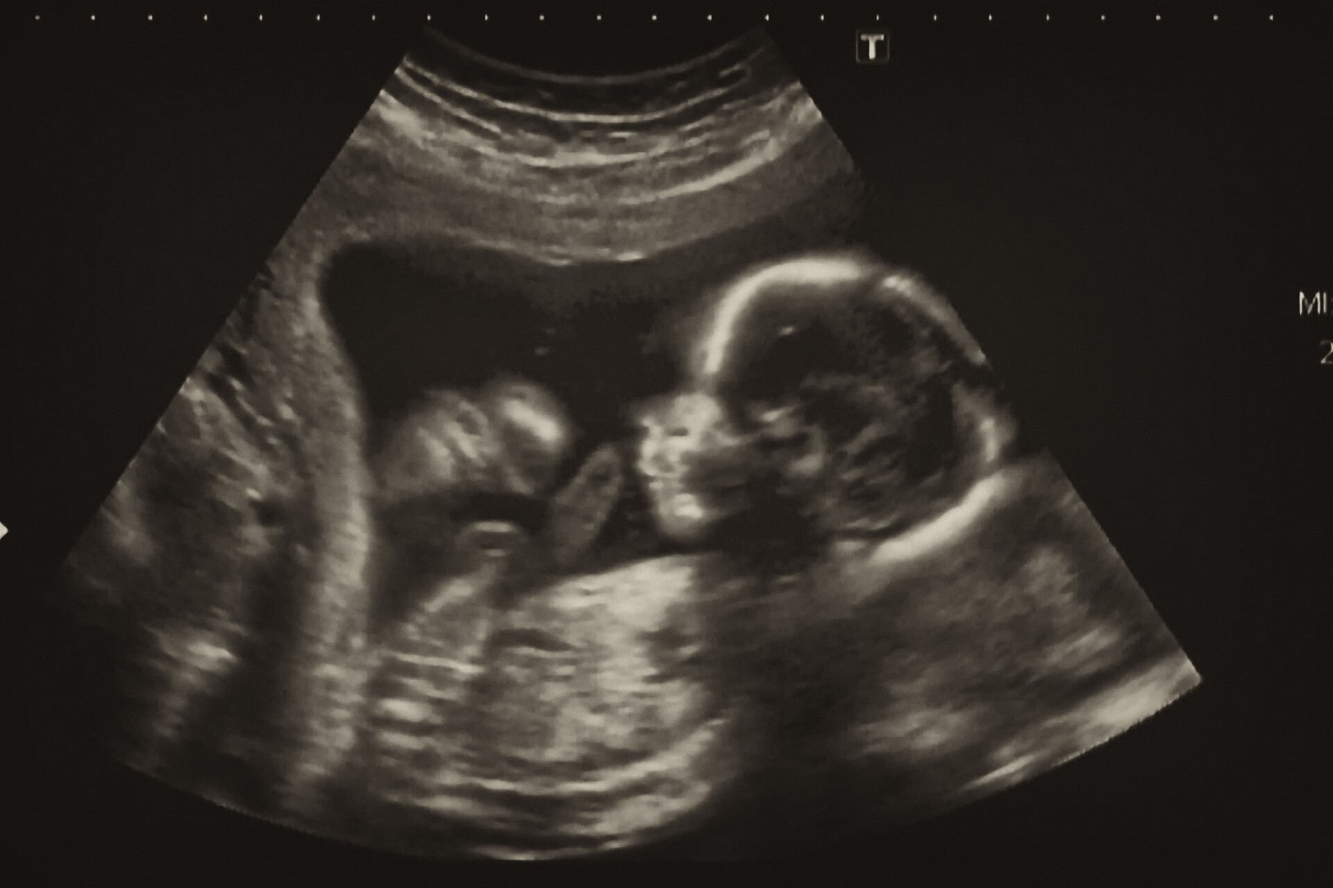 Worldfirst inutero procedure successfully treats dangerous brain defect