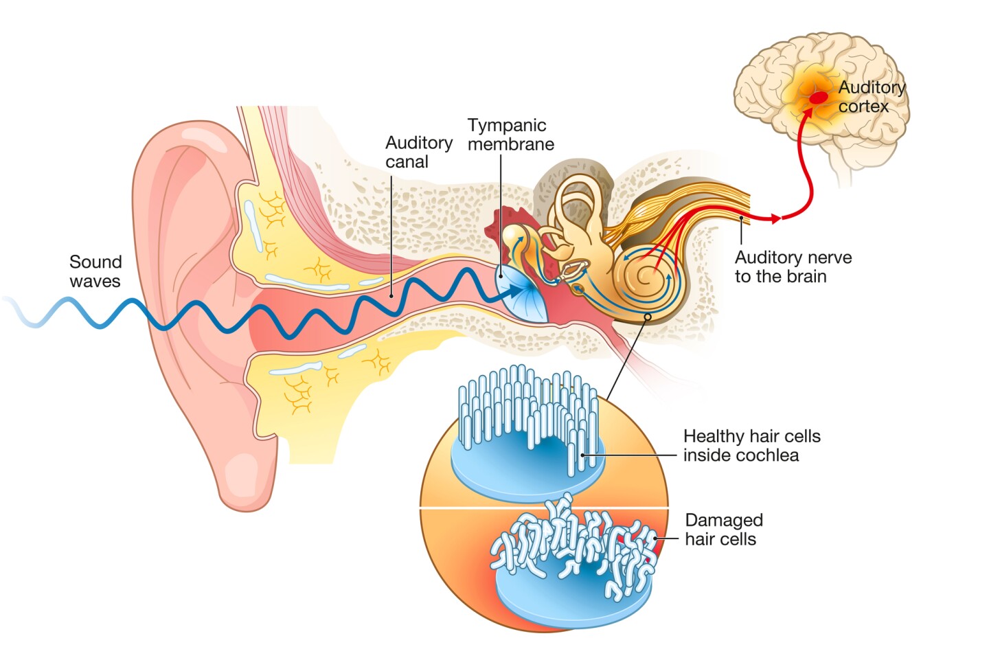 Illustration showing how the ear processes sound, including damaged hair cells inside the cochlea