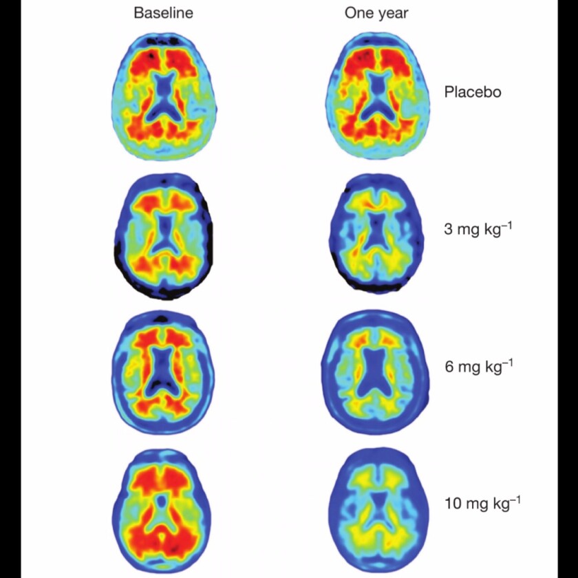 After a full year of treatment, almost no beta-amyloid plaques were observed in the patients receiving he highest dosage of the antibody