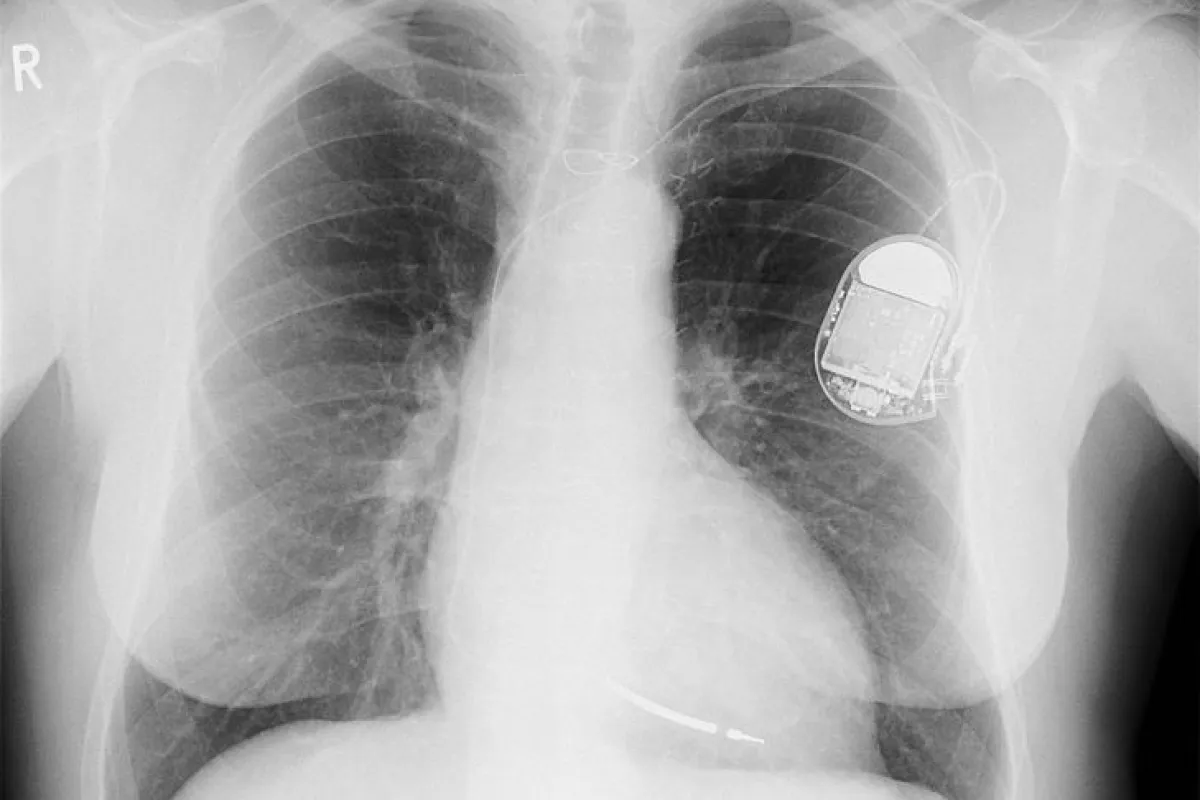Regular implantable defibrillators (like this one) may save patients' lives, but also inflict a lot of pain and trauma (Photo: Wikimedia Commons)