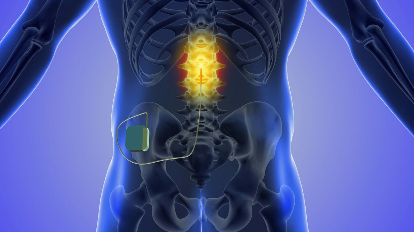 Concept of spinal cord stimulation