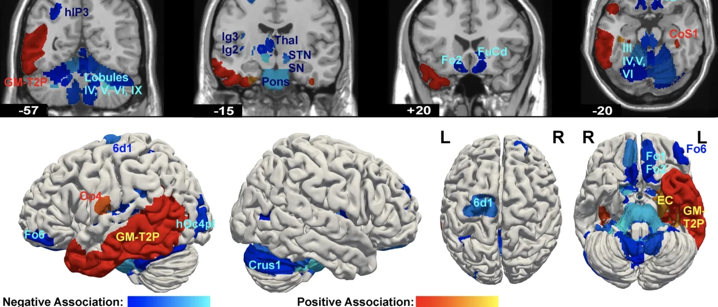 Colored regions show where brain volume was associated with deviant lifestyle and antisocial behaviour in individuals with psychopathic traits