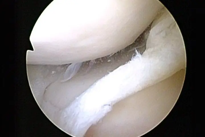 A new type of stem-cell-seeded bandage, designed to heal torn meniscal cartilage such as that pictured above, has been approved for a clinical trial in the UK (Photo: Arthroscopist)