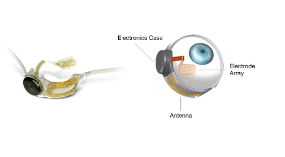 Argus II consists of a tiny video camera mounted in glasses that is wirelessly linked to a receiver and microelectrode array implanted onto the patient's retina