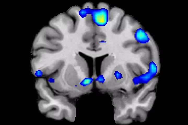 A scan shows regions of the brain that become active when devoutly religious study participants have a spiritual experience