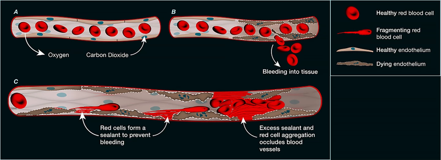 Diagram showing how the red blood cells clog small blood vessels