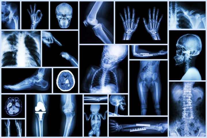 It seems exercise can also blast fat from our skeletons