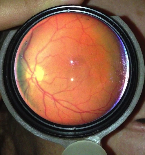 A retinal image obtained using EyeGo
