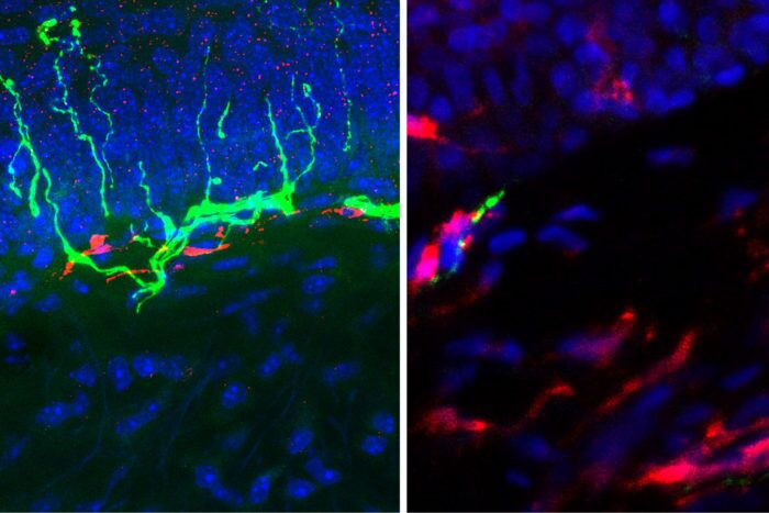Skin biopsies of healthy patients (left) show plenty of sensory nerve fibers (green) with few macrophages (red), while patients with diabetic neuropathy (right) have the opposite