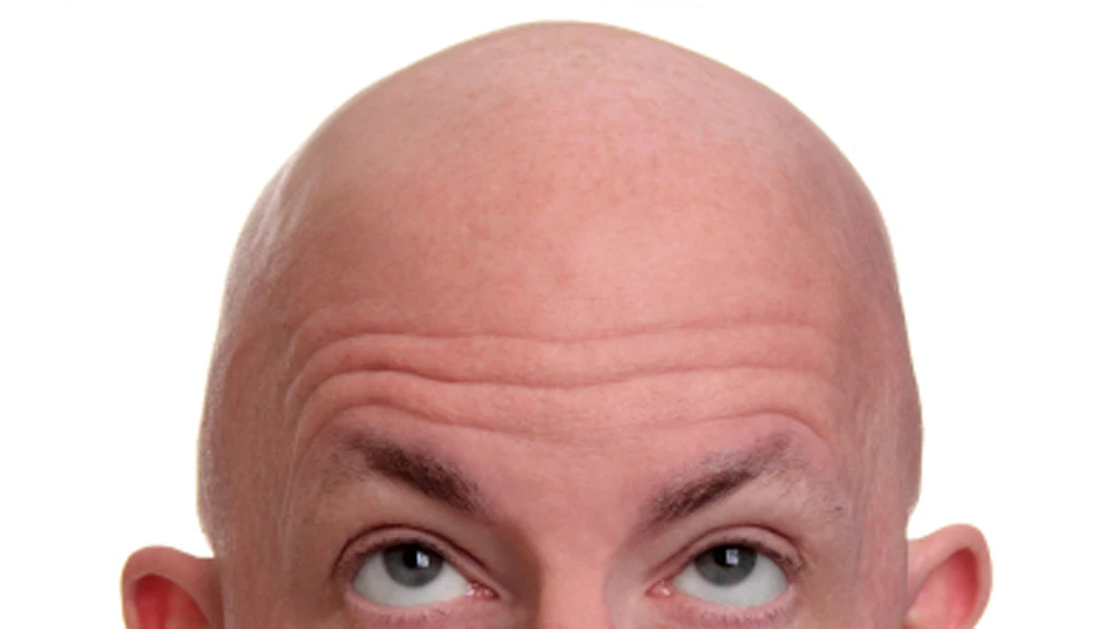 A discovery by Yale researchers could lead to new treatments for baldness
