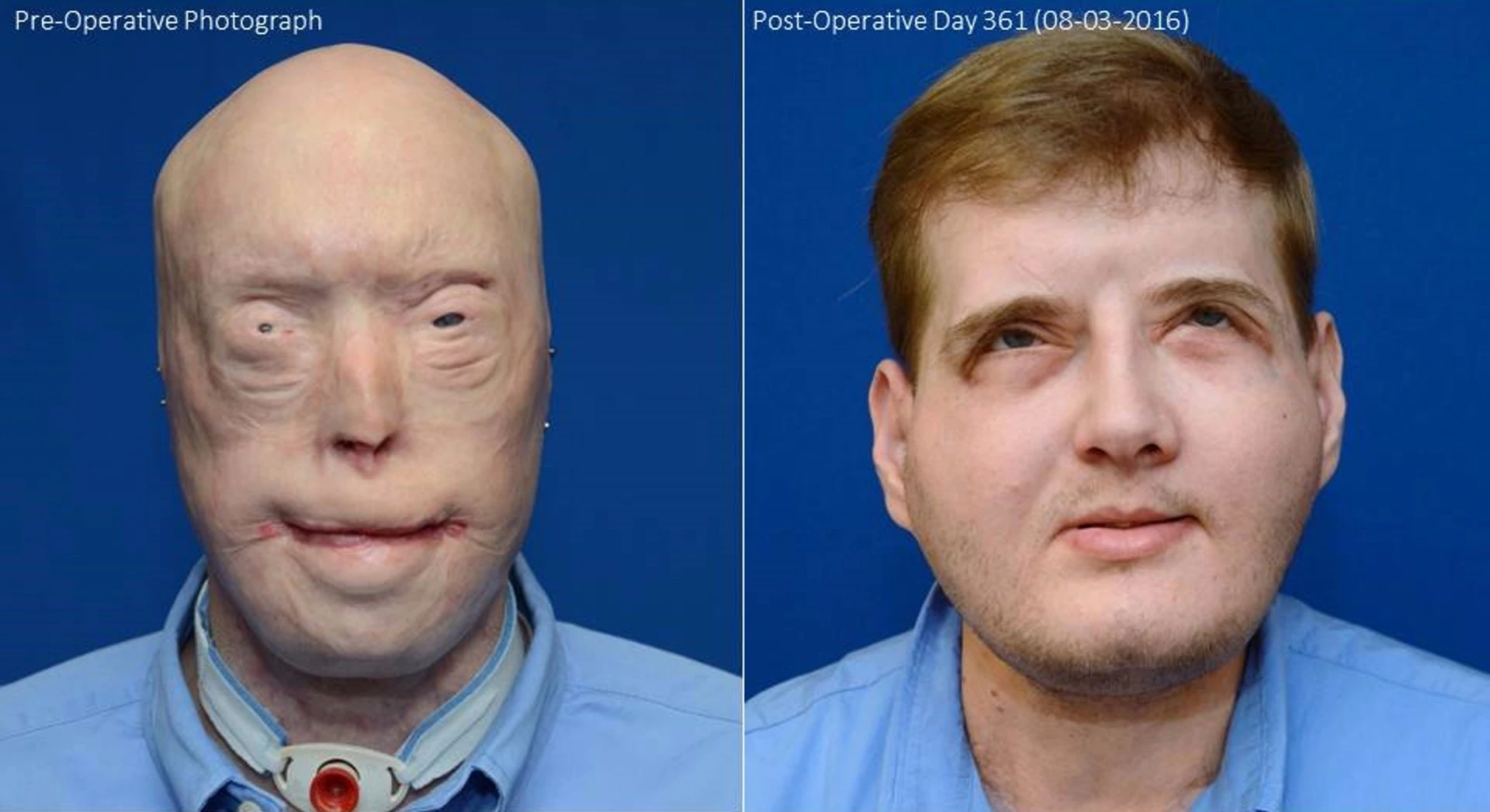 Patrick Hardison before the transplant and a year later