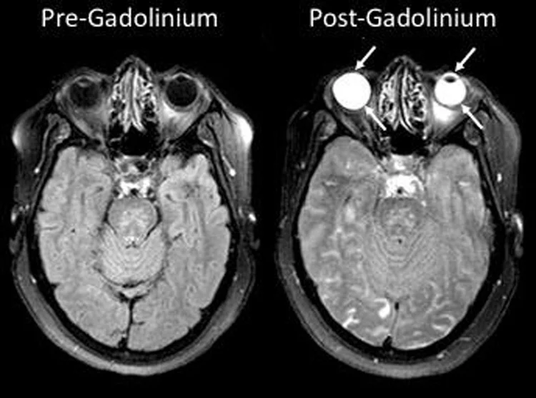 MRI scan images showing stroke patients before and after the injection of gadolinium, which has leaked into the eyes