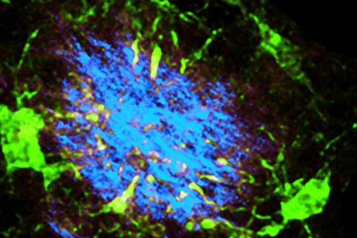 Brain plaques (seen in blue) and other debris are normally swept away by cells called microglia (seen in green). But this process is impacted when the microglia is missing a protein called TREM2, as in the image above (Image: Yaming Wang, Bernd Zinselmeyer/Washington University in St Louis)