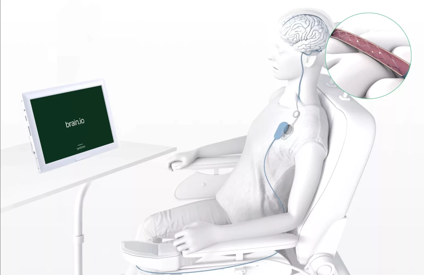 The stentrode, power pack and wireless transmitter are implanted under the skin. A receiver sits nearby, capable of transmitting decoded signals to a computer, mobile device, or anything else