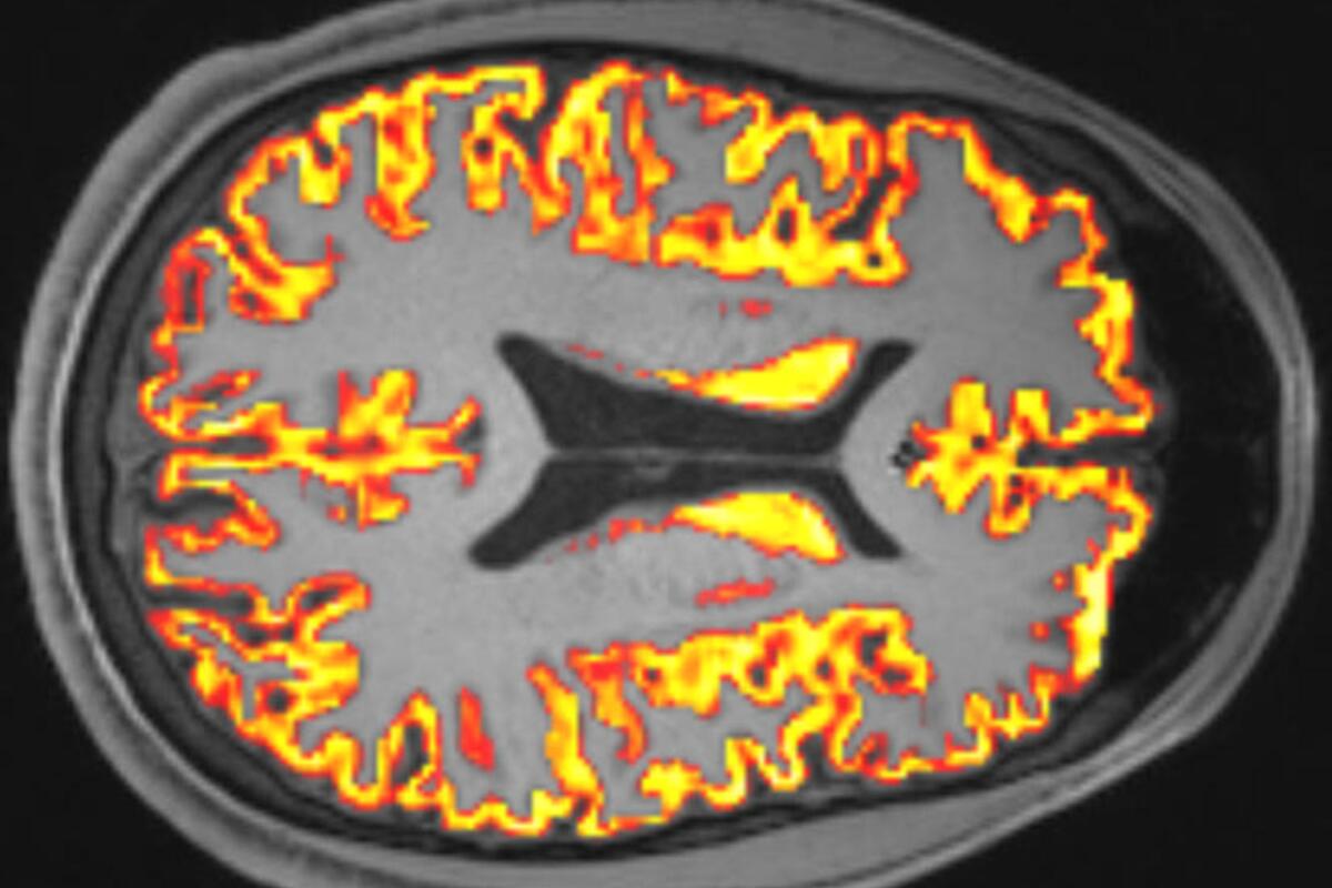 Researchers looked at how COVID and long COVID correlated with microstructural changes to the brain