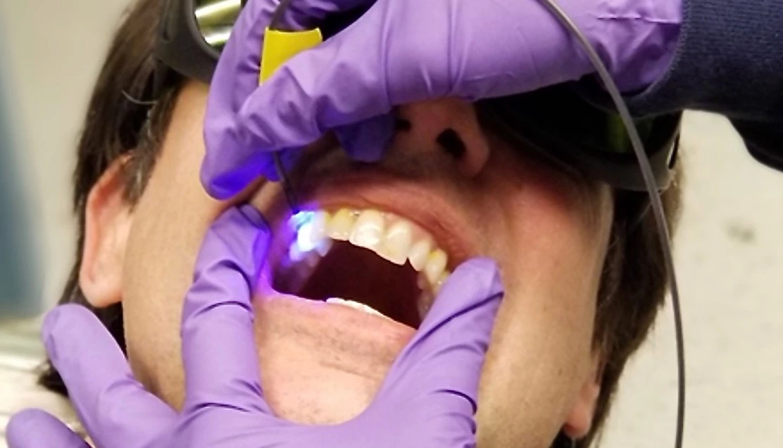 A new system used a mix of LED light and chemical dye to detect warning signs of tooth decay