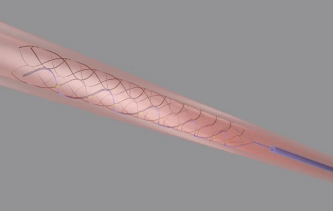 Barely the size of a paperclip, the new stentrode transmitting device is said to be able to allow people to use their own thoughts to control exoskeletons or prosthetic limbs