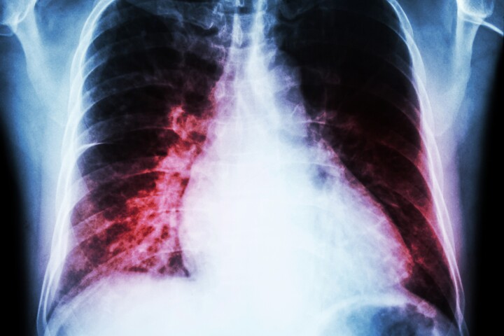 A study has discovered the cellular mechanisms underpinning heart failure and a drug that reverses the damaging malfunction