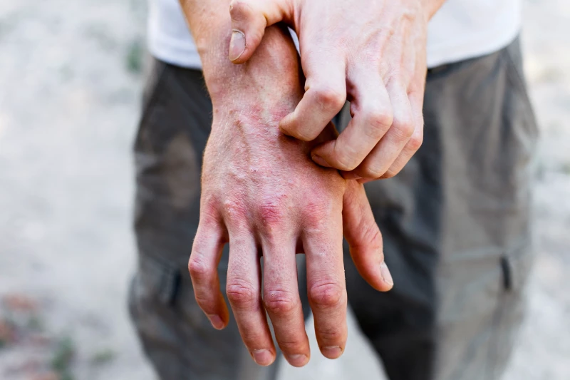 New Eczema Therapy Shows Promising Relief In Phase 2 Clinical Trials ?url=https%3A%2F%2Fnewatlas Brightspot.s3.amazonaws.com%2Fba%2F73%2F3ba2f5fc400f94ffbdff57ff6a2f%2Fdepositphotos 207376112 L