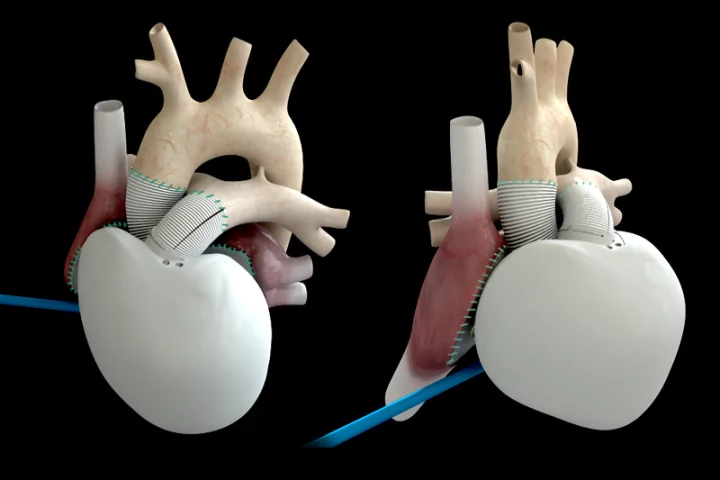 Renderings of an implanted Carmat artificial heart
