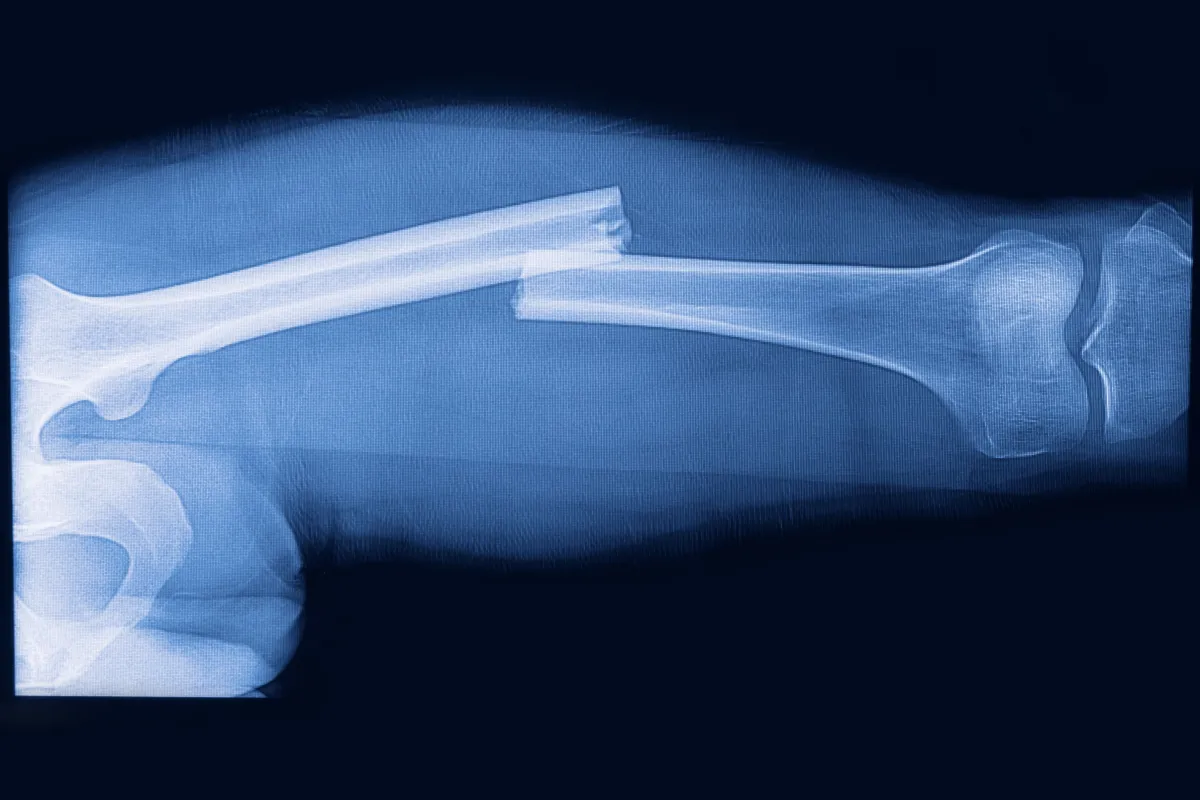 A implantable material made from a blend of plastics has been developed to regrow damaged bones (Image: Shutterstock)