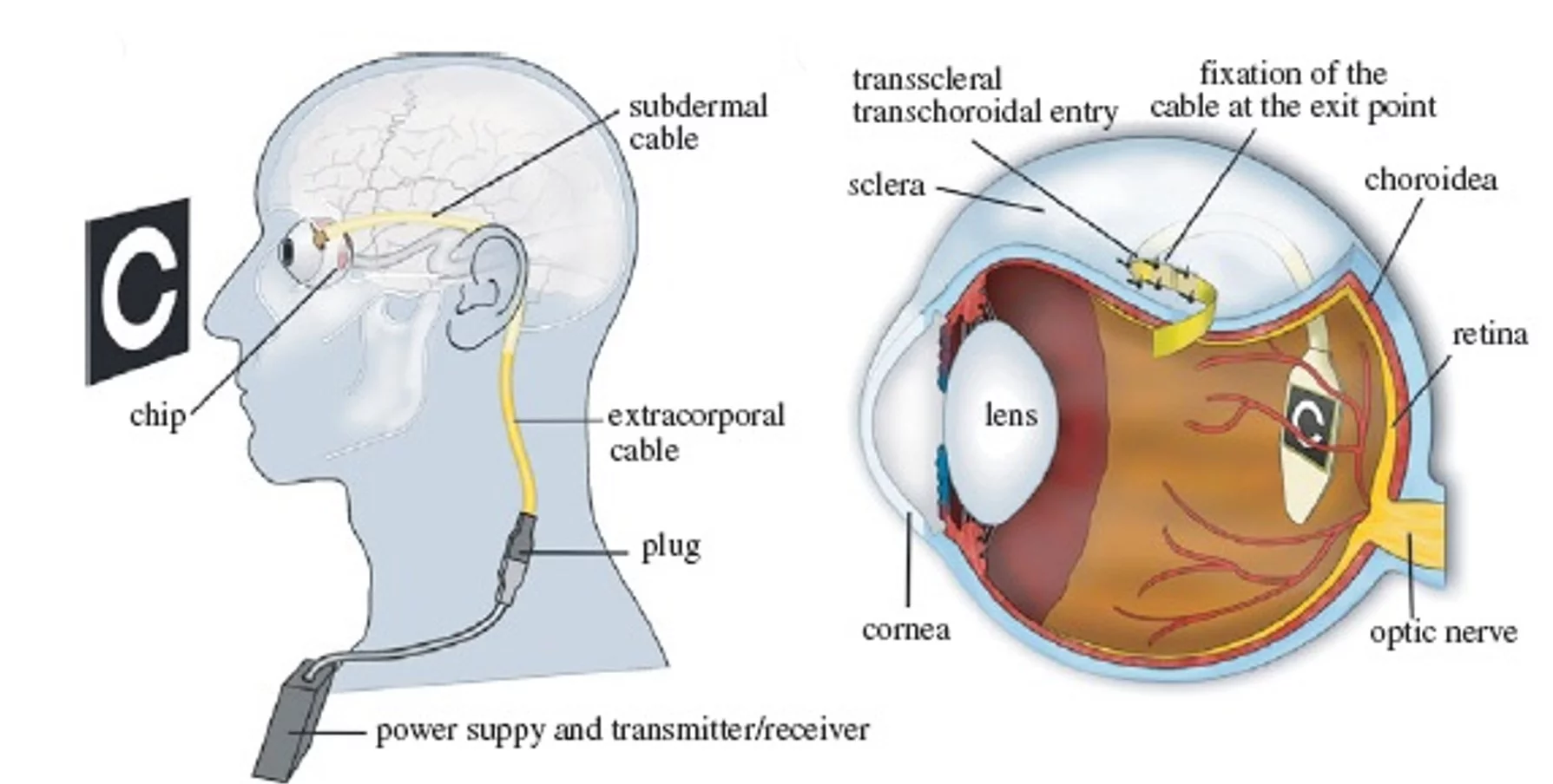 Diagram showing implant set up (Image: Retinal Implant AG)