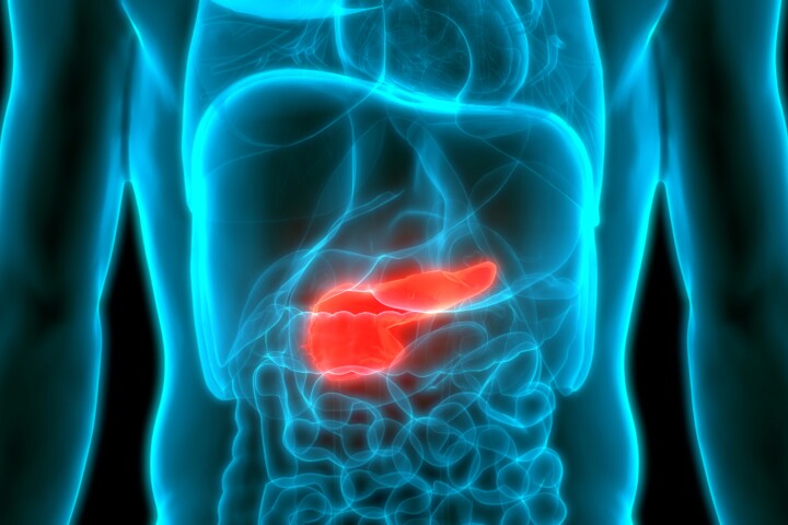 A study has found a link between high blood insulin levels and pancreatic cancer