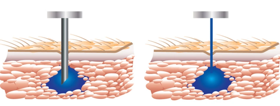 Rather than jam a sharp metal tube through a patient's skin, PRIME delivers its drug payload in the form of a high-pressure stream of liquid