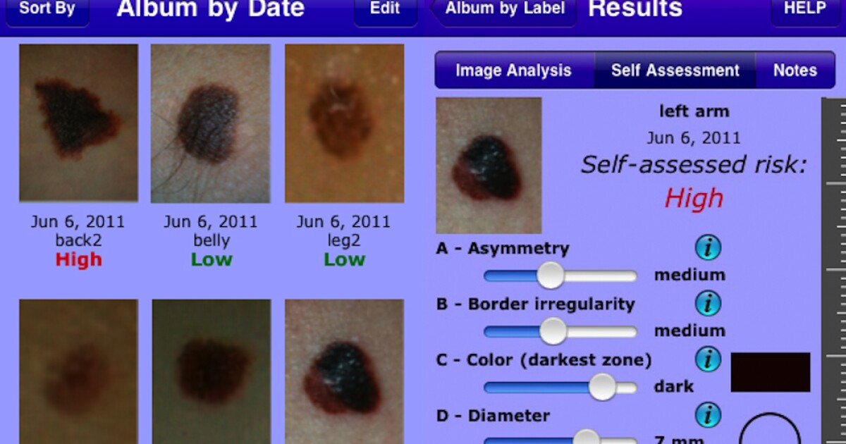 iPhone app provides skin cancer risk assessment