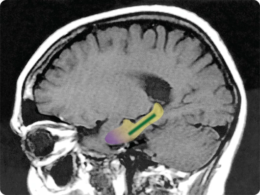 Cocoa flavanol improved age-related memory decline in the dentate gyrus (shown in green) (Photo: Lab of Scott A. Small, MD)