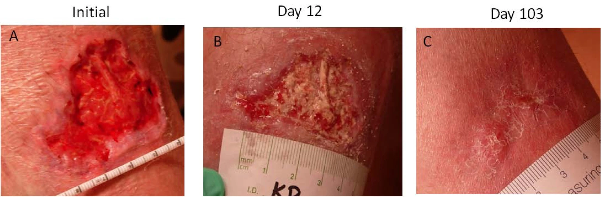 The progress of a wound treated with DermaFuse