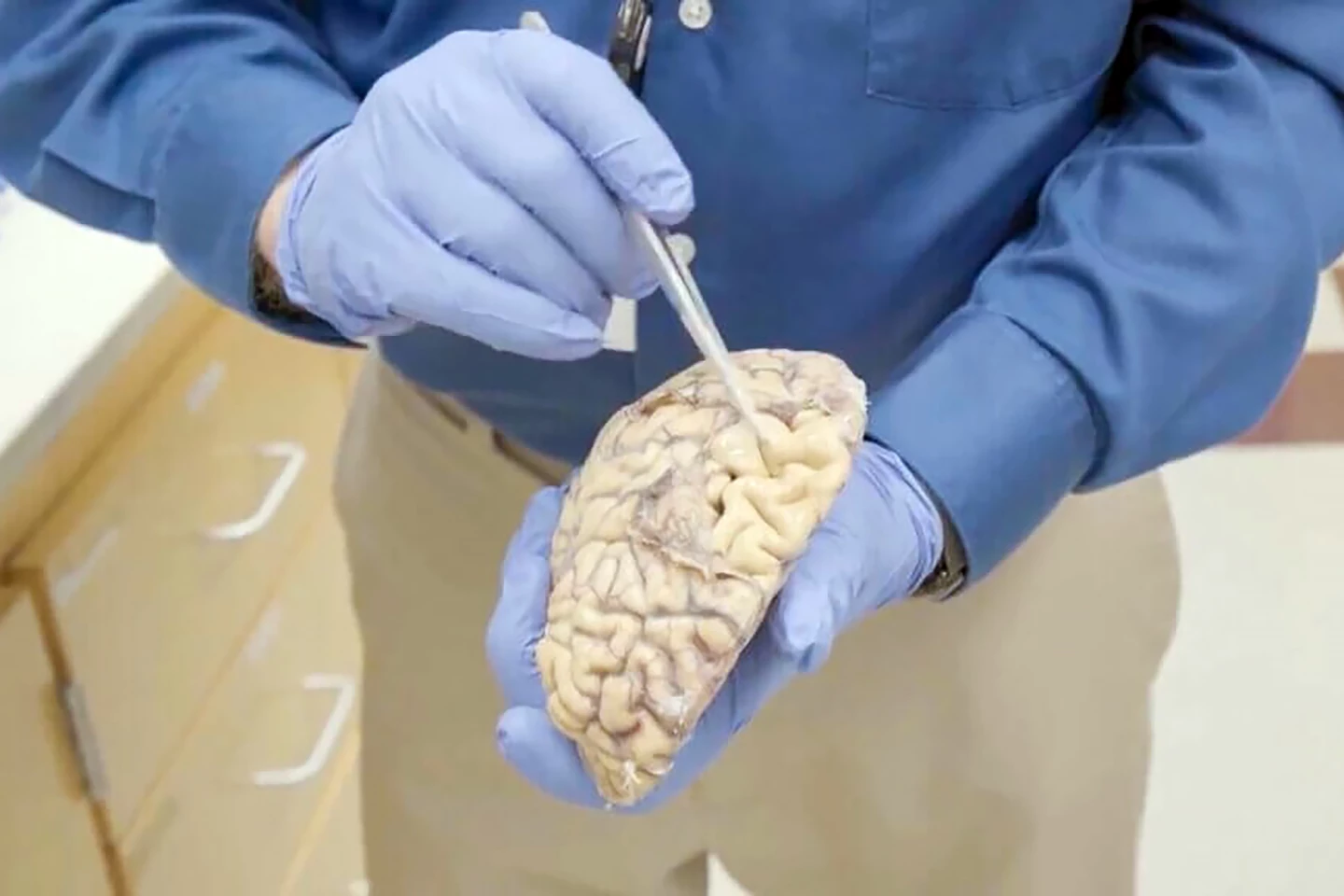 UW Medicine pathologist C. Dirk Keene, M.D., points out large grooves in the surface of the donated brain of someone who died from Alzheimer’s disease