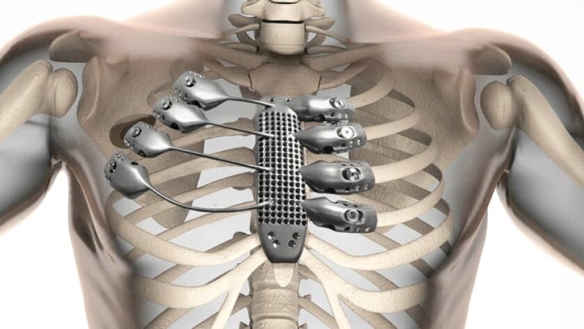3D printing technology has enabled a replacement sternum and rib cage customized for a specific patient