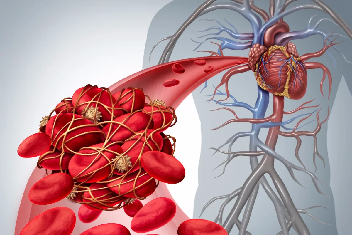A new technique shines light through a patient's blood during surgery, to alert surgeons at the first sign of a potentially dangerous clot