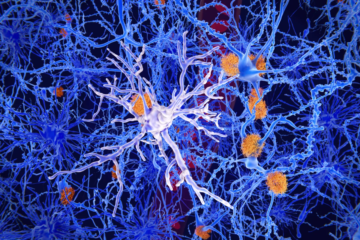 Stem cell transplants have shown promise in treating Alzheimer's disease in mice by replacing microglia, the brain's immune cells