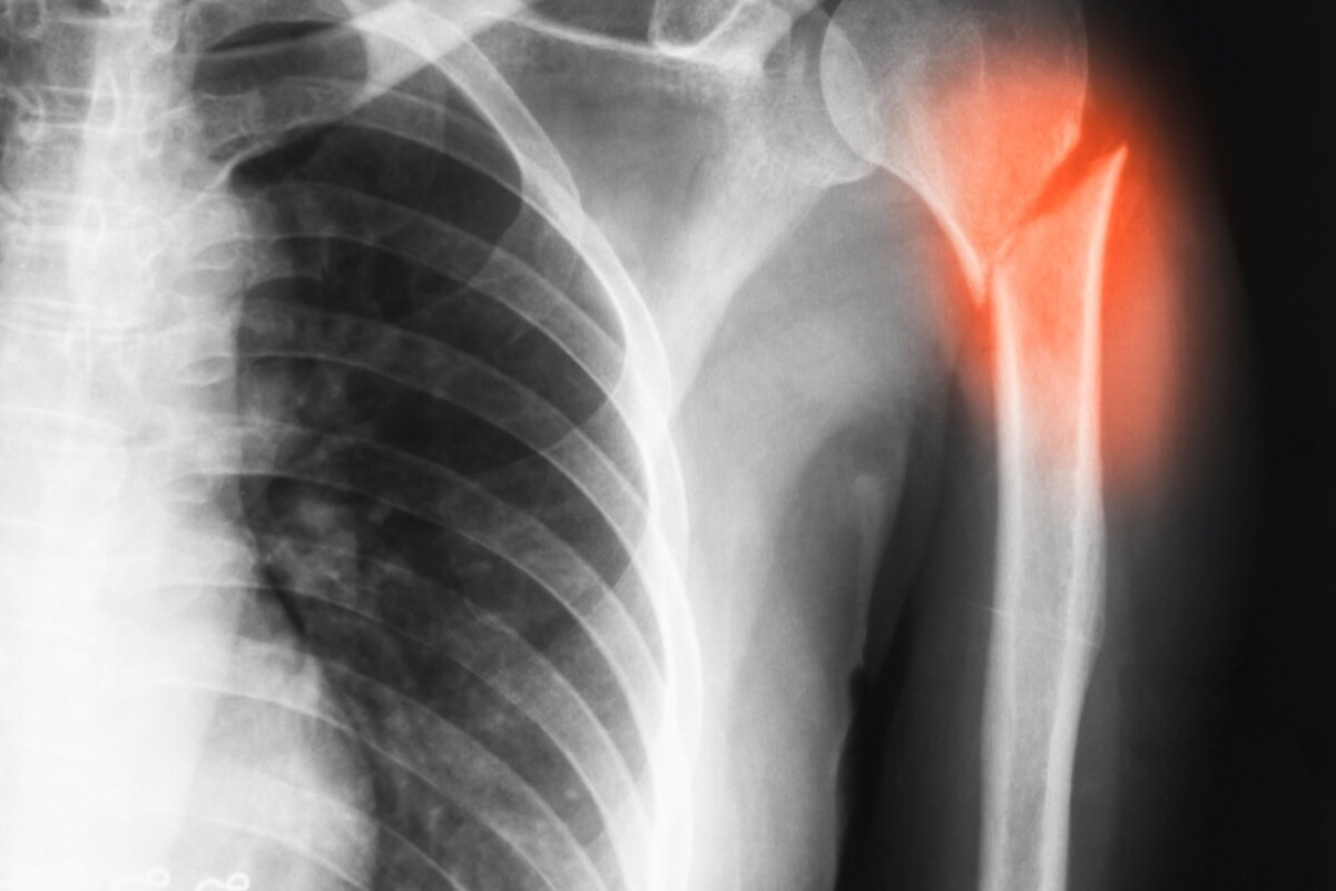 Biodegradable Implant Could Simplify Bone Replacement Surgery
